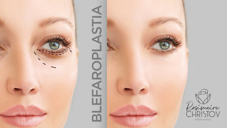 blefaroplastia-com-plasma-sp