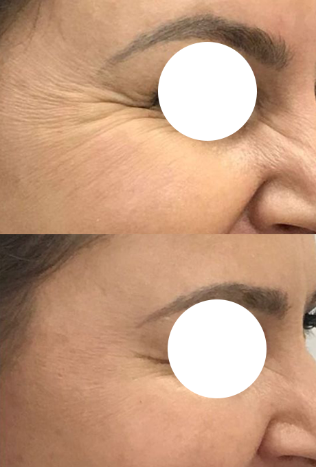 resultado-botox-sp
